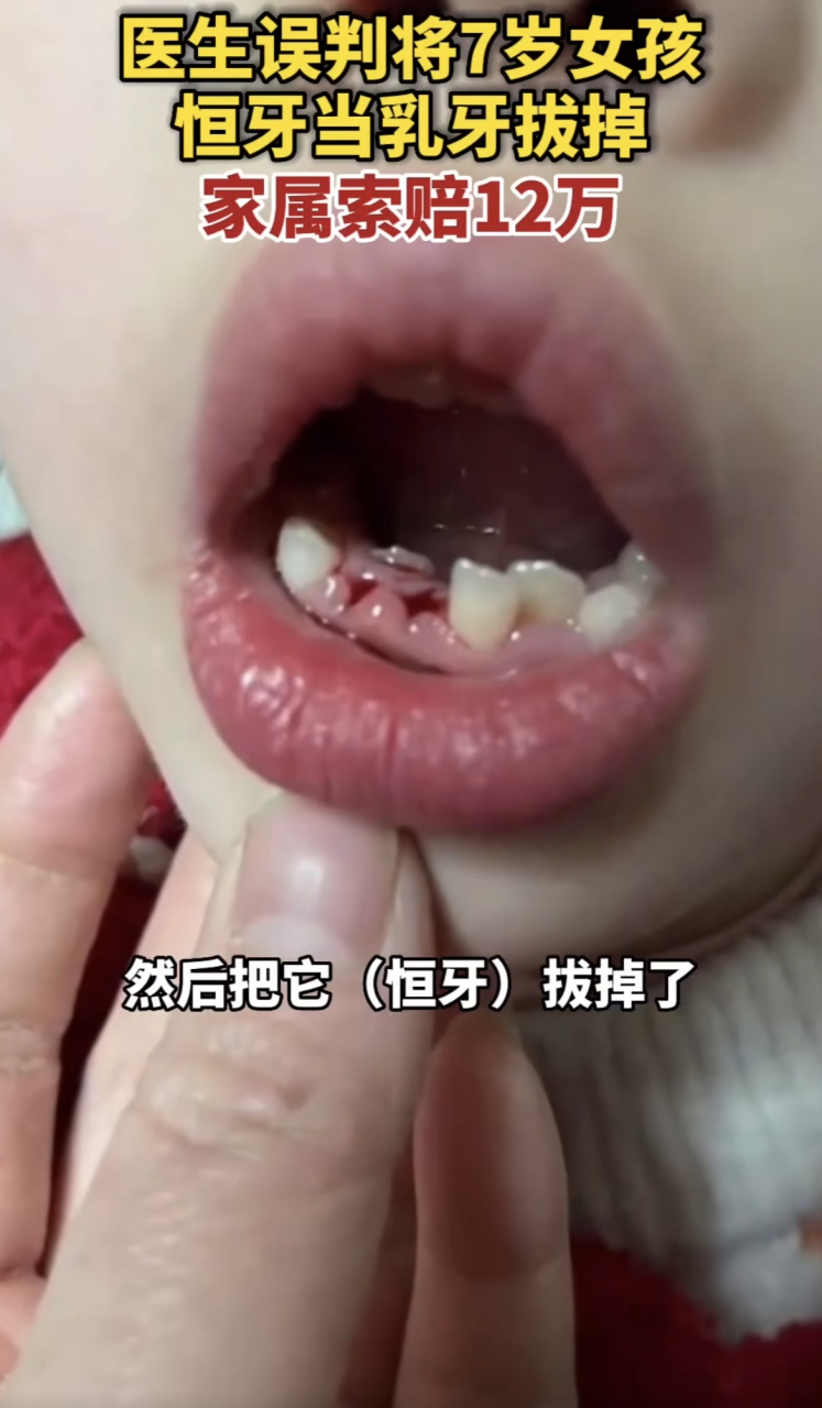 医生误判将7岁女孩恒牙当乳牙拔掉!家属索赔12万