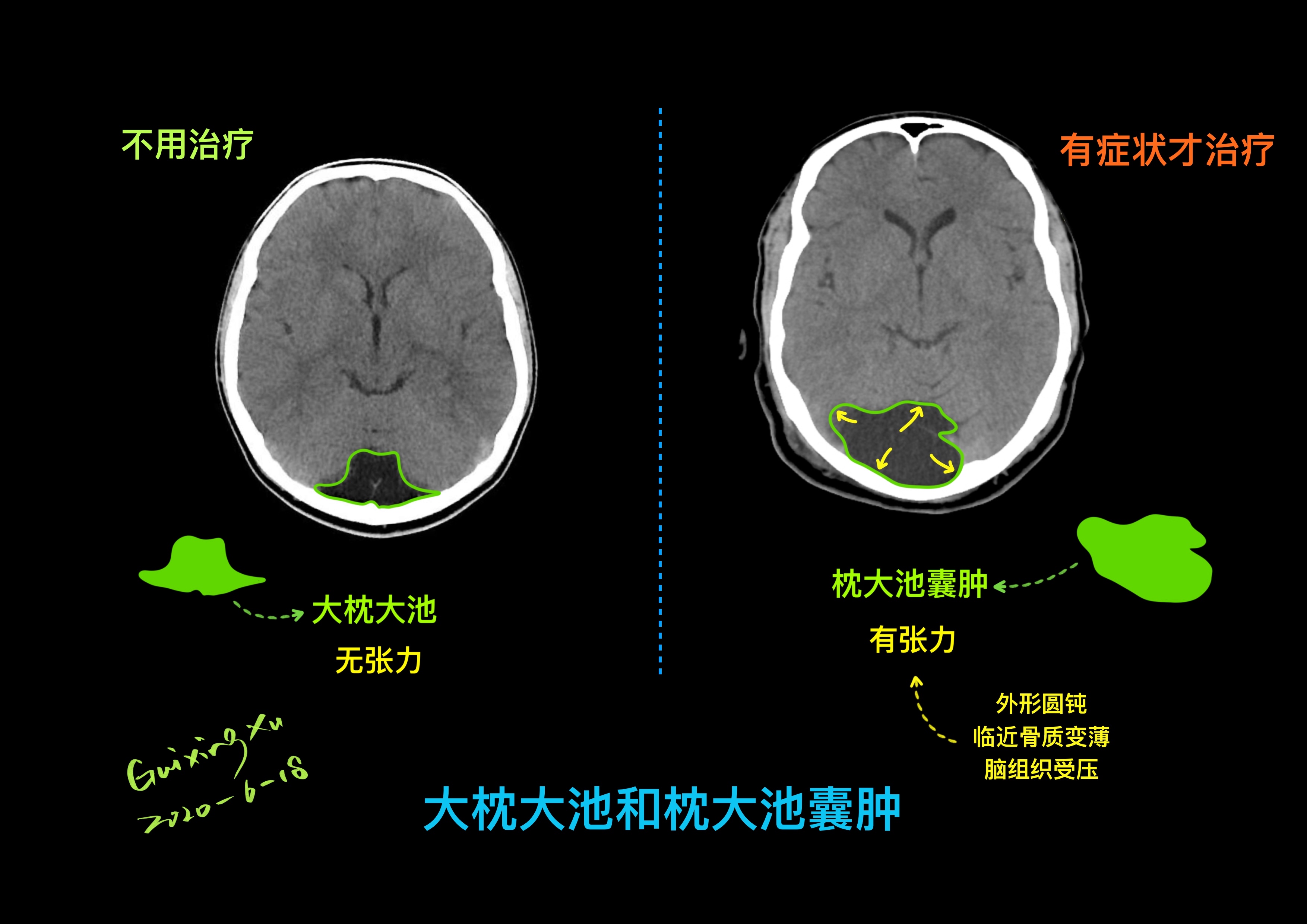 枕大池囊肿手术费用图片