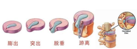 椎间盘突出