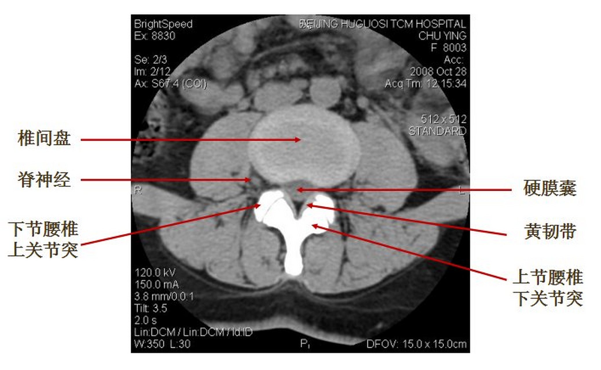 正常腰椎ct图解图片