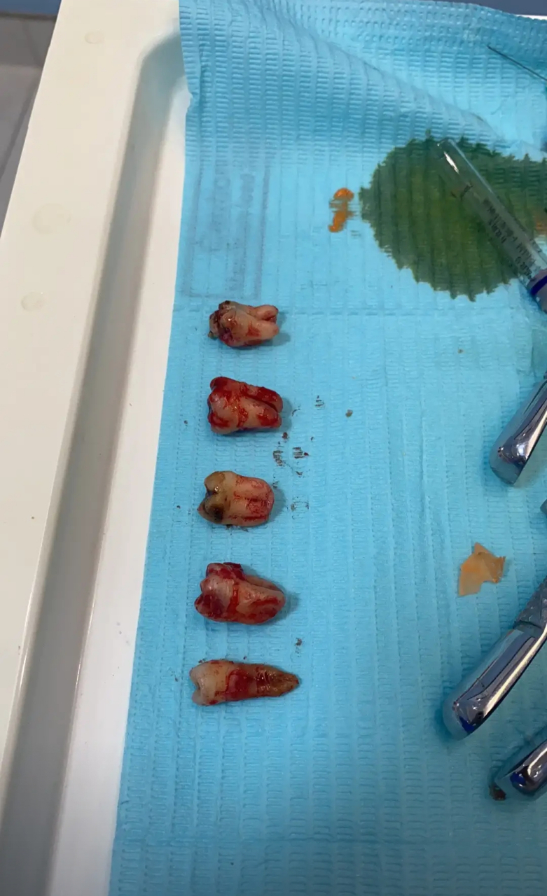 我一次性拔了4个智齿,一颗牙齿.