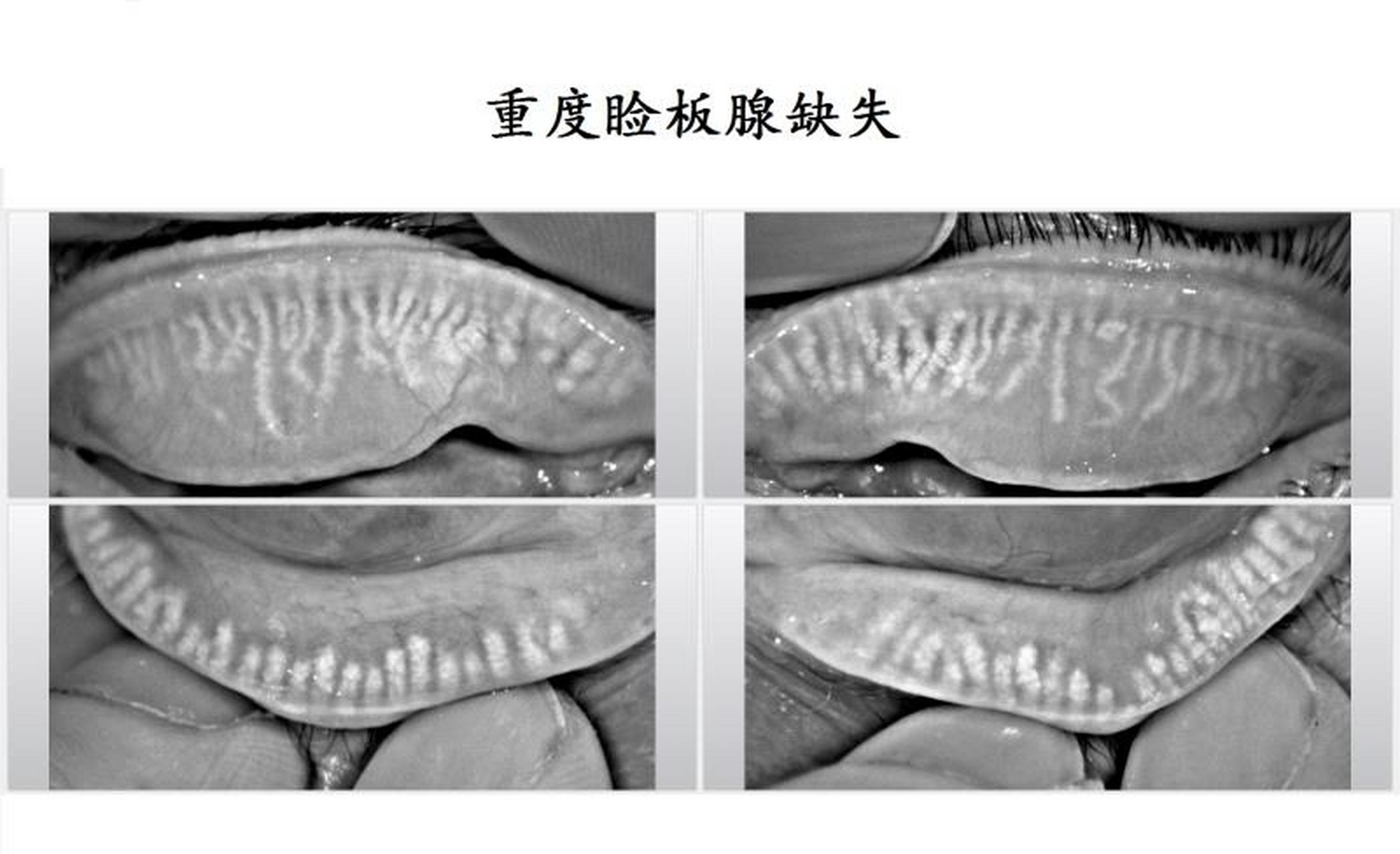 门诊一位睑板腺萎缩缺失特别严重的患者,接近下图.