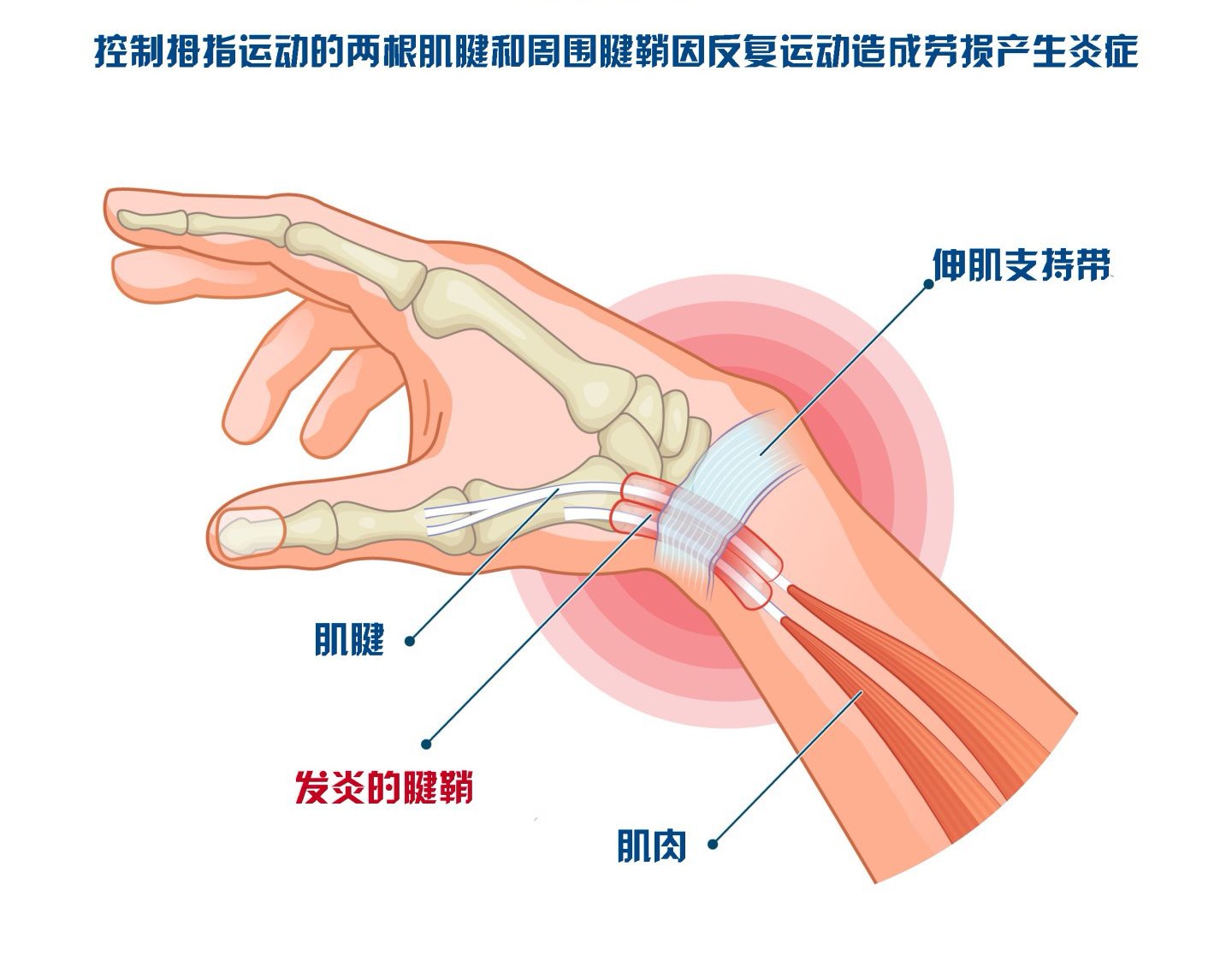 腕屈肌和腕伸肌图片