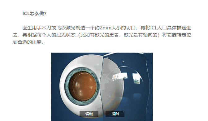 成都爱尔周进解析1000,1800度近视患者可选?摘镜方案!