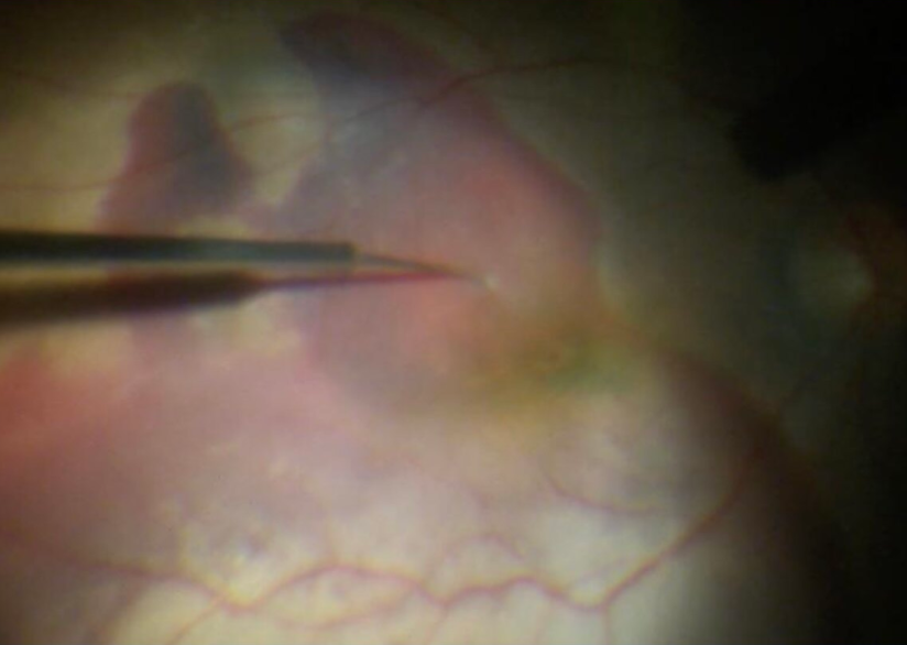 温医大附属眼视光医院吴荣瀚主任突破手术禁区为患者守住最后光明