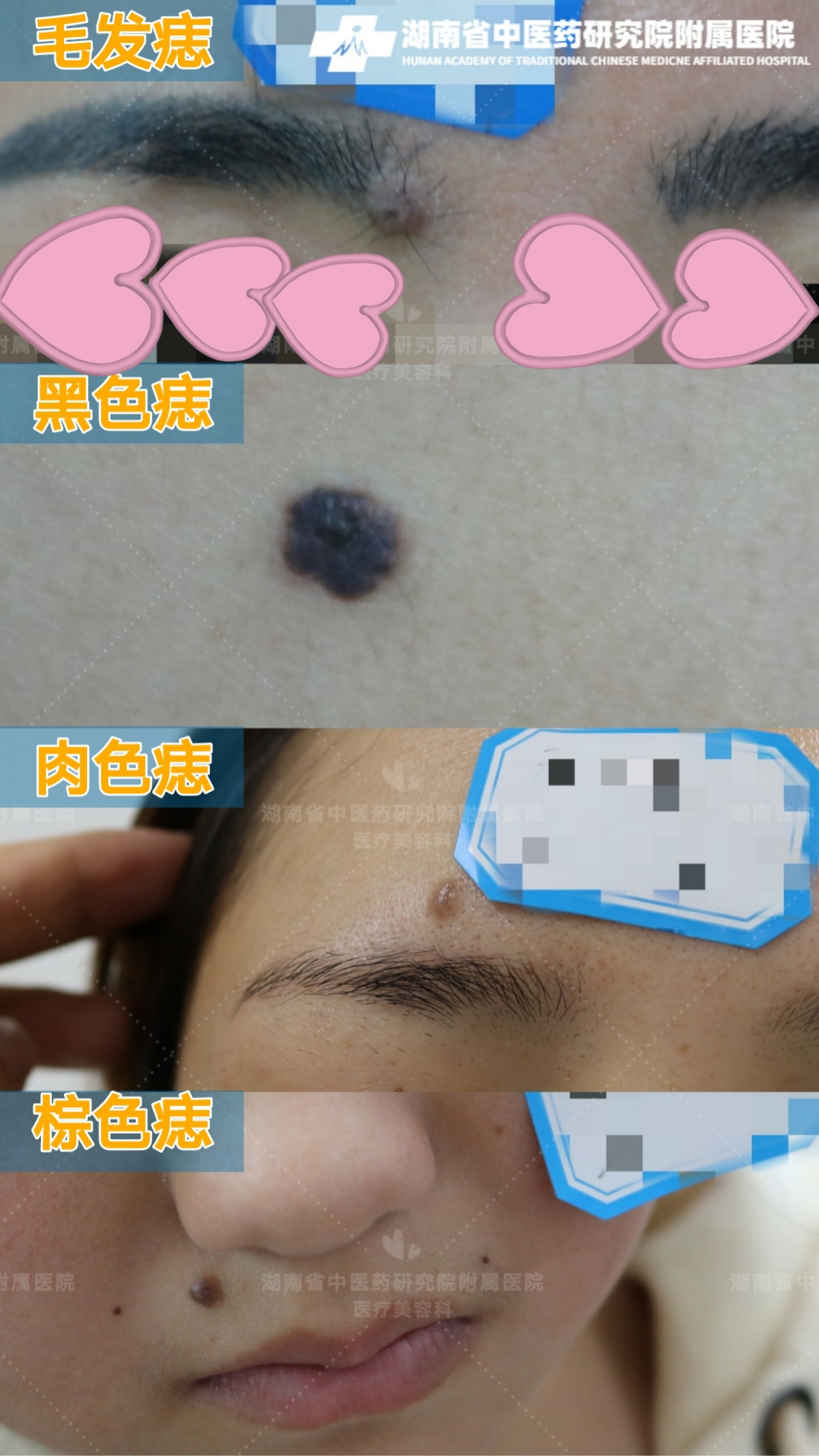 肉痣越来越大是怎么回事?【湖南省中医药研究院附属医院】