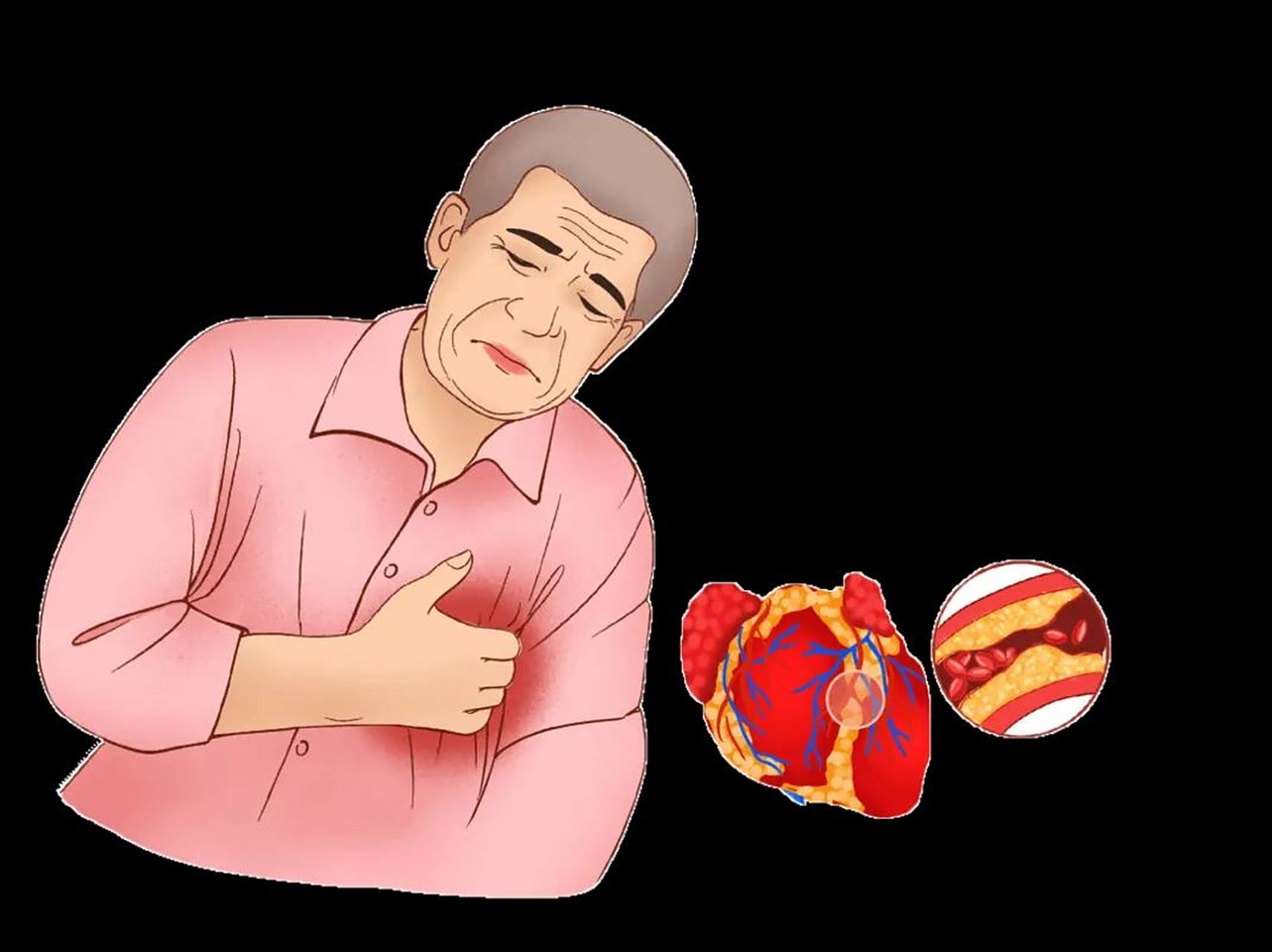 打通心脑血管瘀堵,一个4味药的良方,远离心梗脑梗!