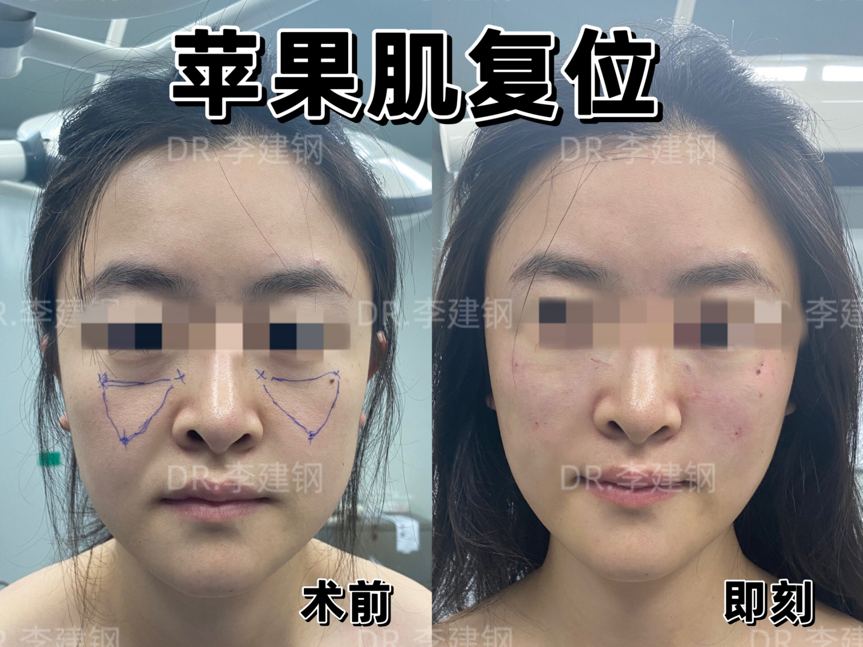 32岁求美者苹果肌复位  该求美者比较年轻,但是苹果肌下垂特别明显