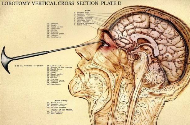 把疯子变傻子的脑前额叶切除术,堪称诺贝尔奖的耻辱,却受尽追捧