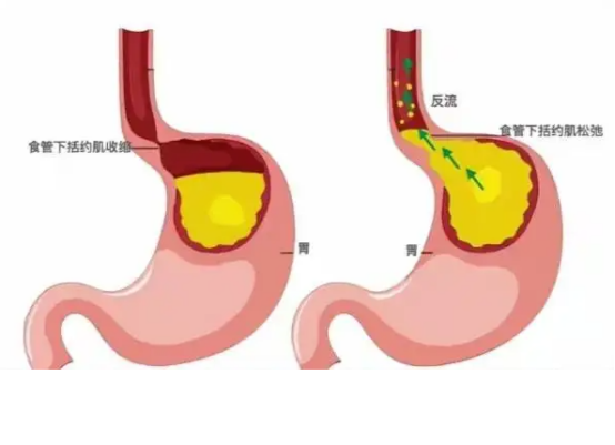 反流性食管炎的诱因有哪些?