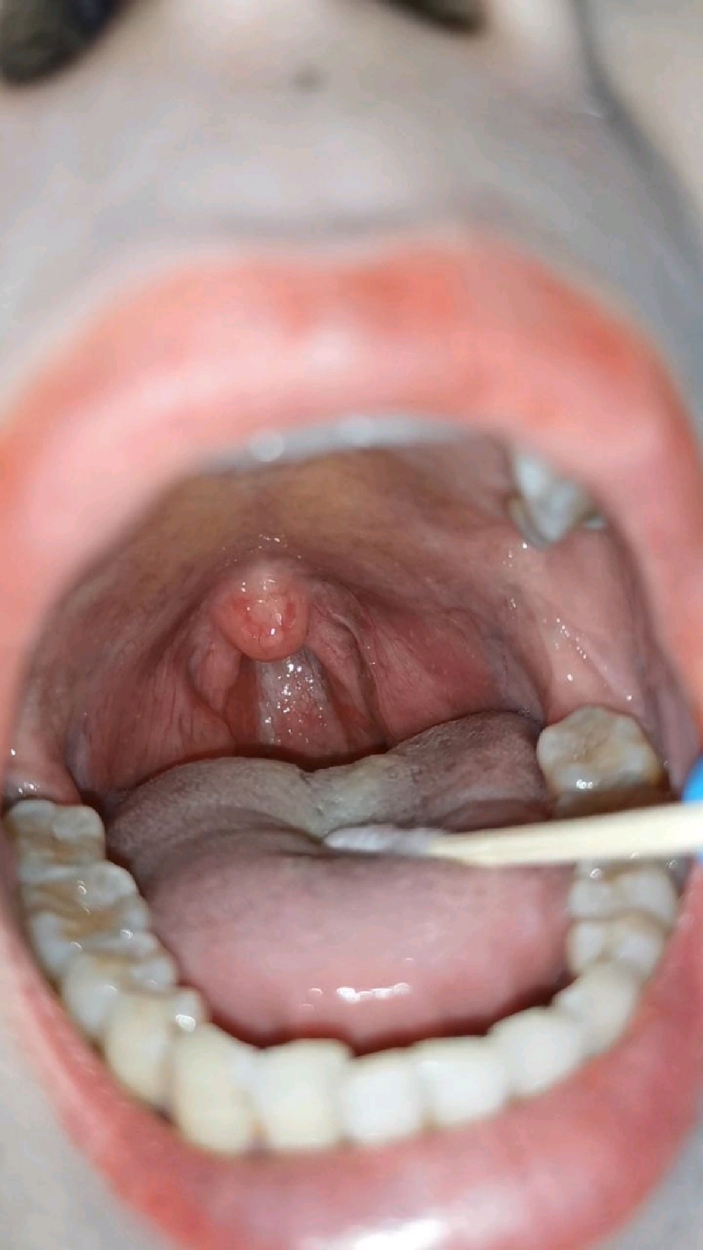 天天打呼噜,仰卧打呼噜,不胖也打呼噜,女性也打