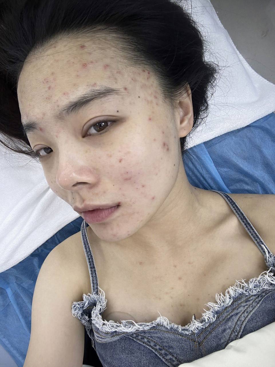 妈耶,怎么办,不敢出门了!这真的是酒精过敏吗?