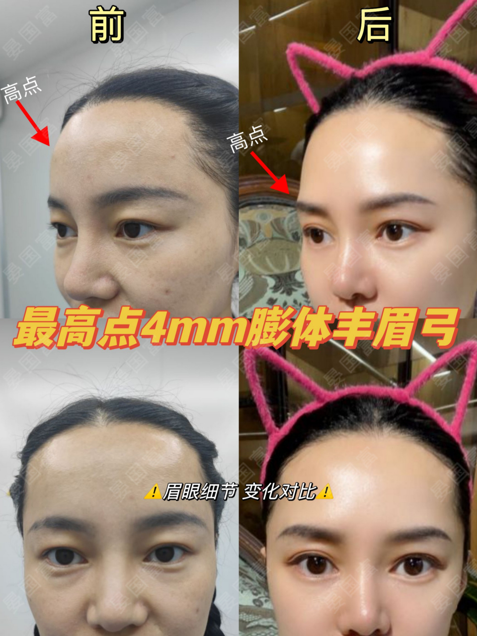的上图可参考)弱化额头高点达到上面部和谐立体自然的丰眉弓案例对比