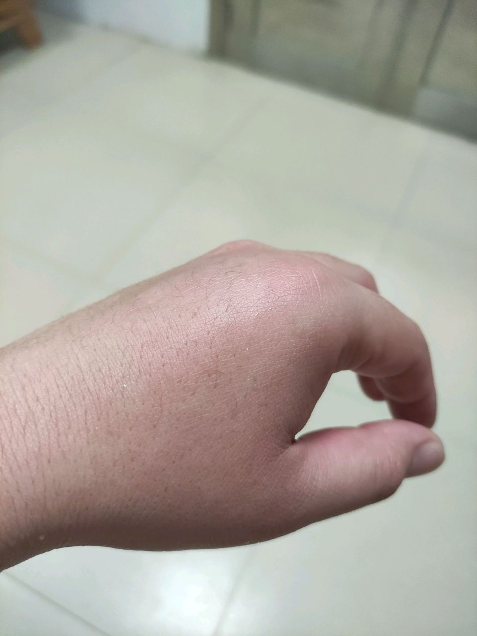 刚刚被一只大黑蜂蛰了一下, 不到半个小时, 手就开始肿了, 刚蛰那会儿