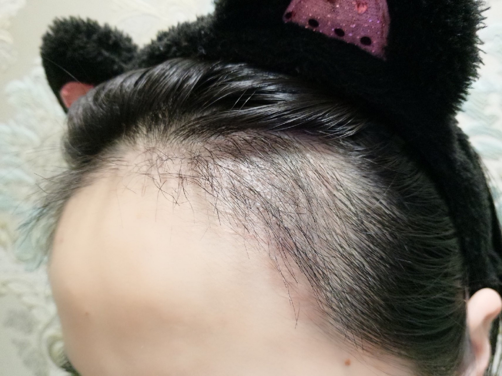 头包脸的秘密,不剃头植发真香体验6015 我的发际线比较高,山羊角