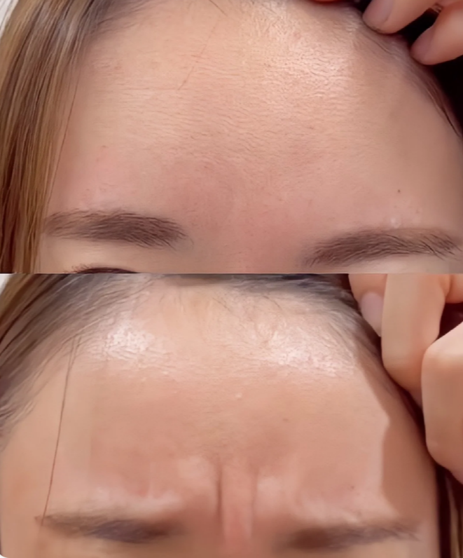 了解川字纹动态和静态两种类型