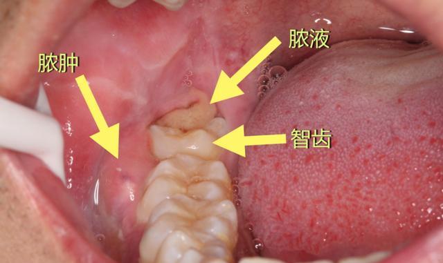 古人都有智齒,為什麼要拔掉智齒?古人牙痛怎麼辦?