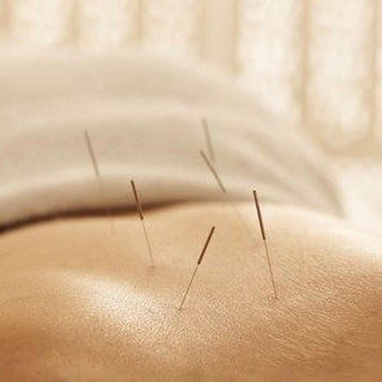 【中西医技能考试历年真题】演示提捏进针法.