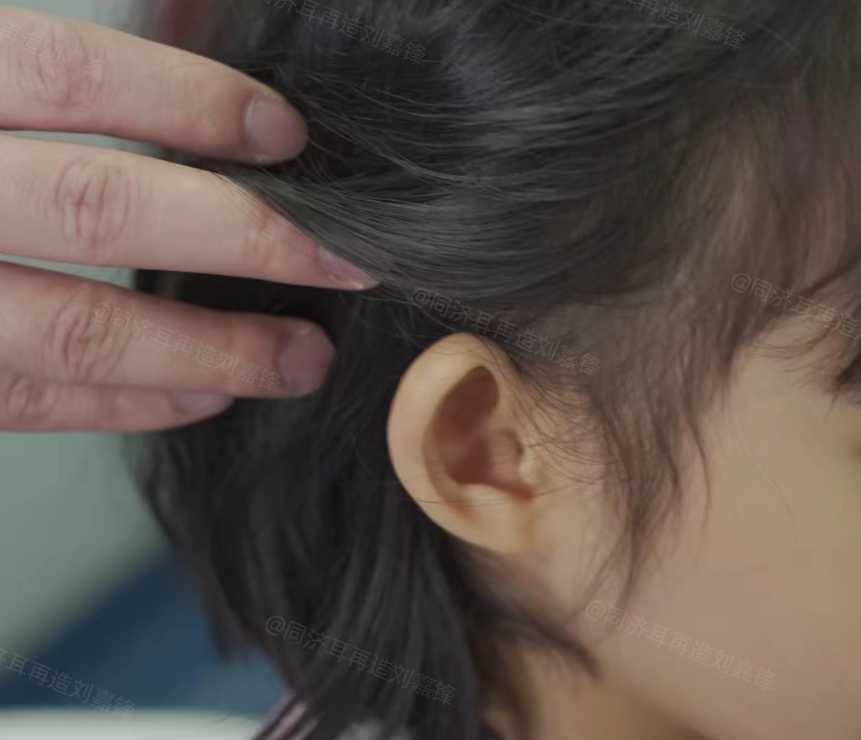 孩子天生招风耳,妈妈说是爸爸遗传的,不好看,偏要手术!