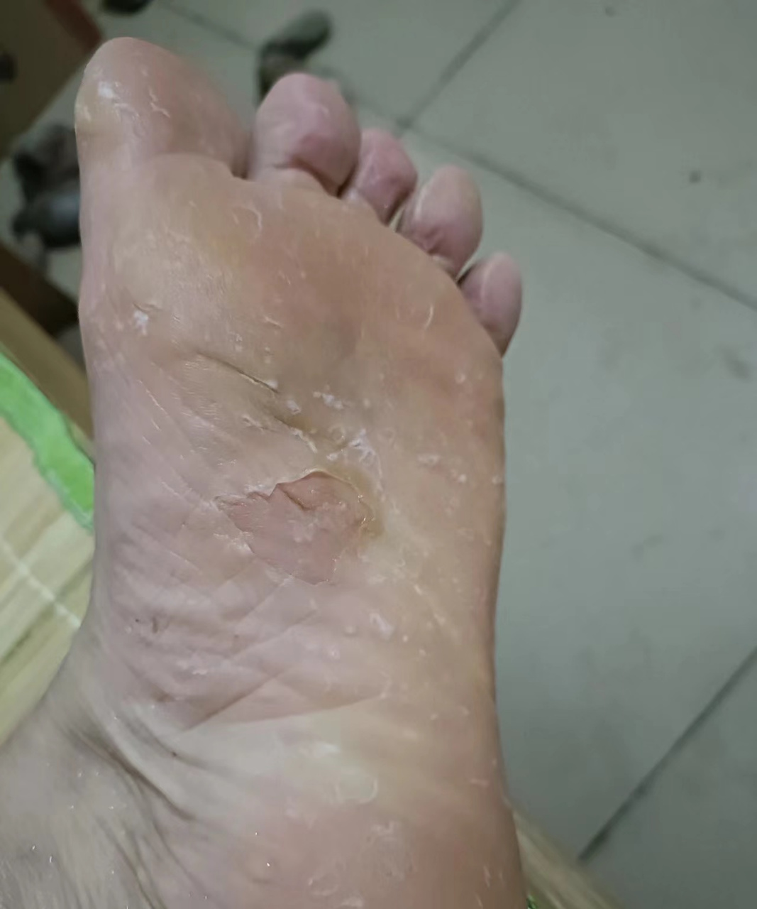 香港脚症状图片