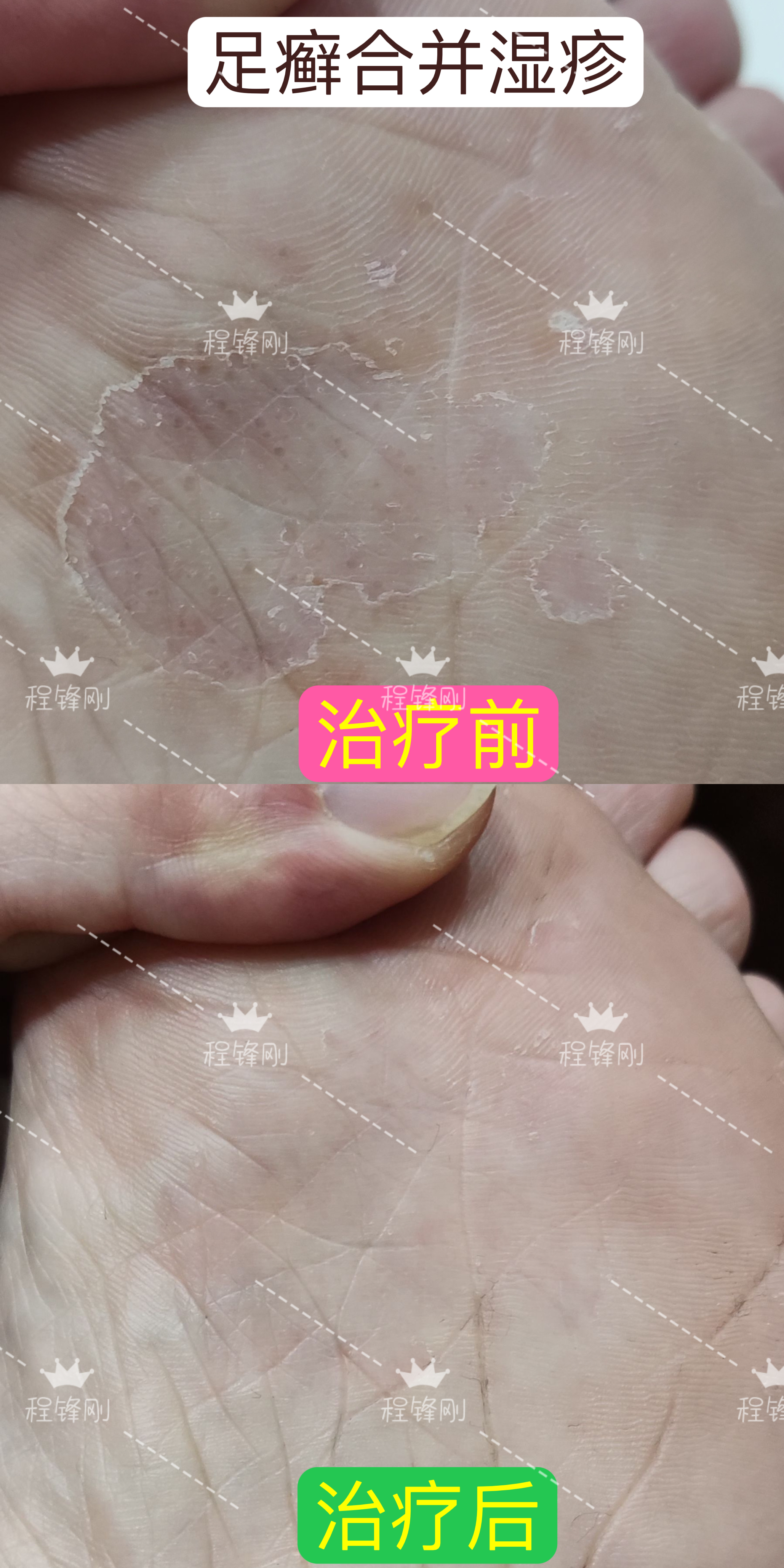 37岁男性,脚底出现水泡.@皮肤科博士程锋刚的动态