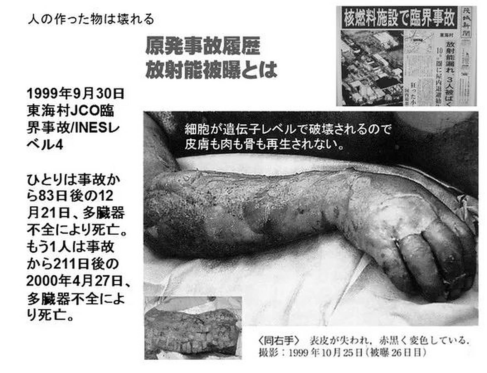 日本男人惨遭核辐射,全身融化生不如死