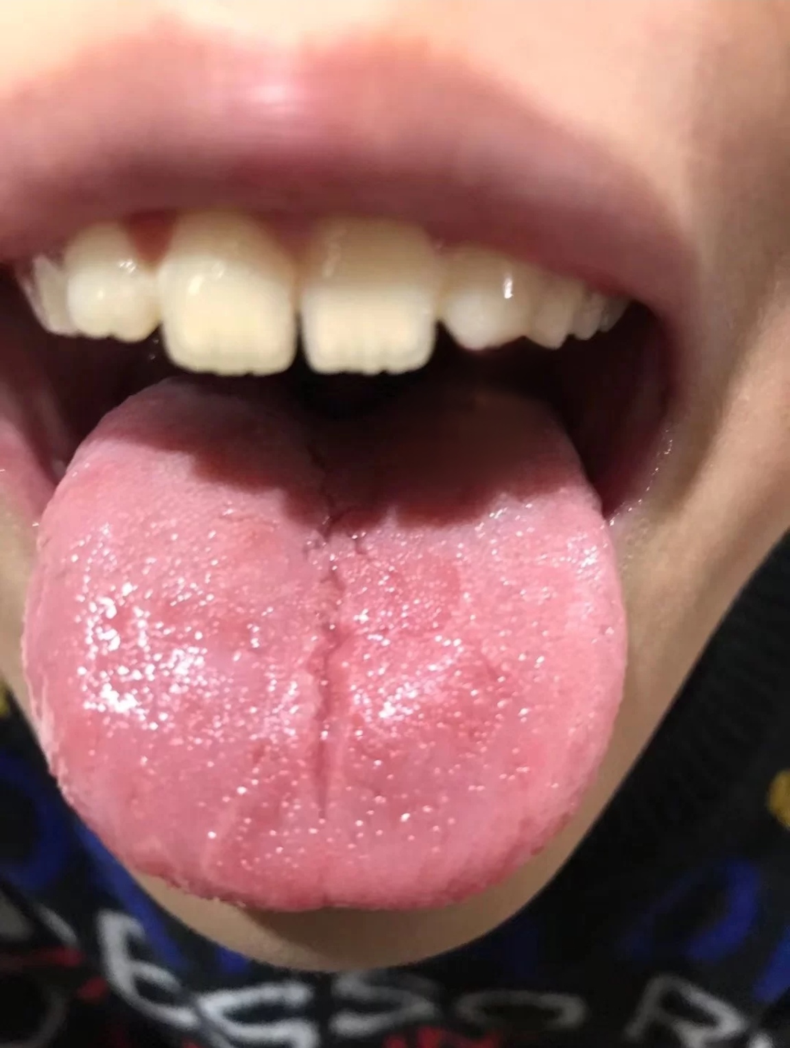 舌尖红有烧灼感是什么原因?