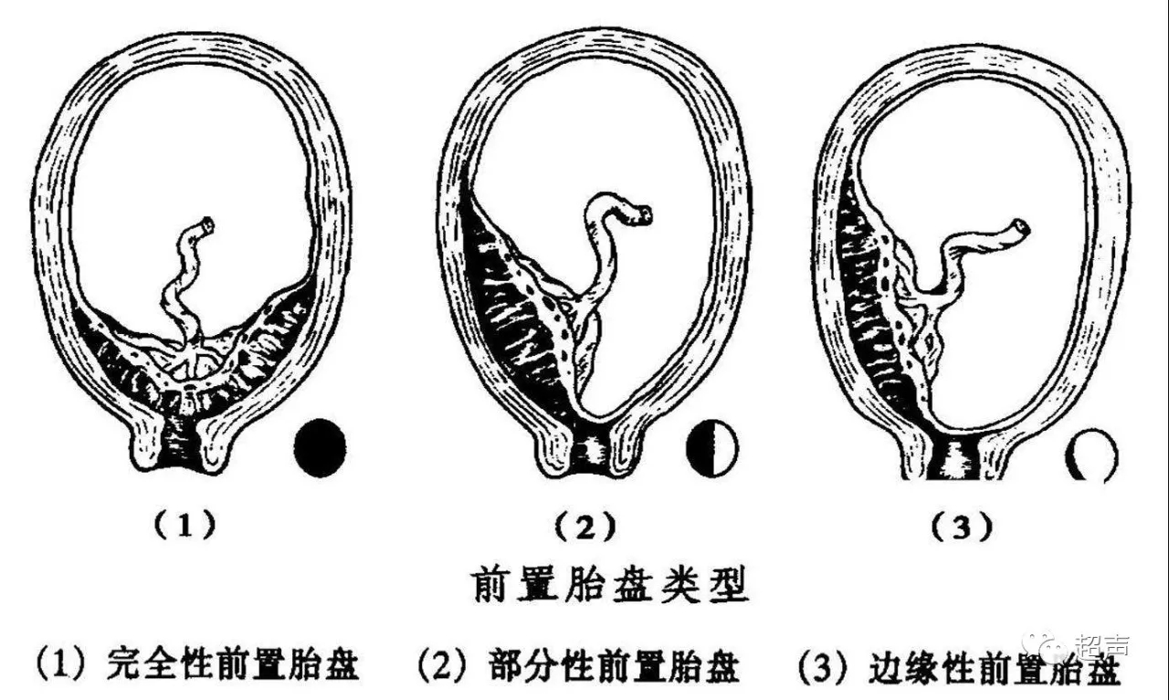 产科"杀手"之前置胎盘,孕妈妈们知道该如何处理吗