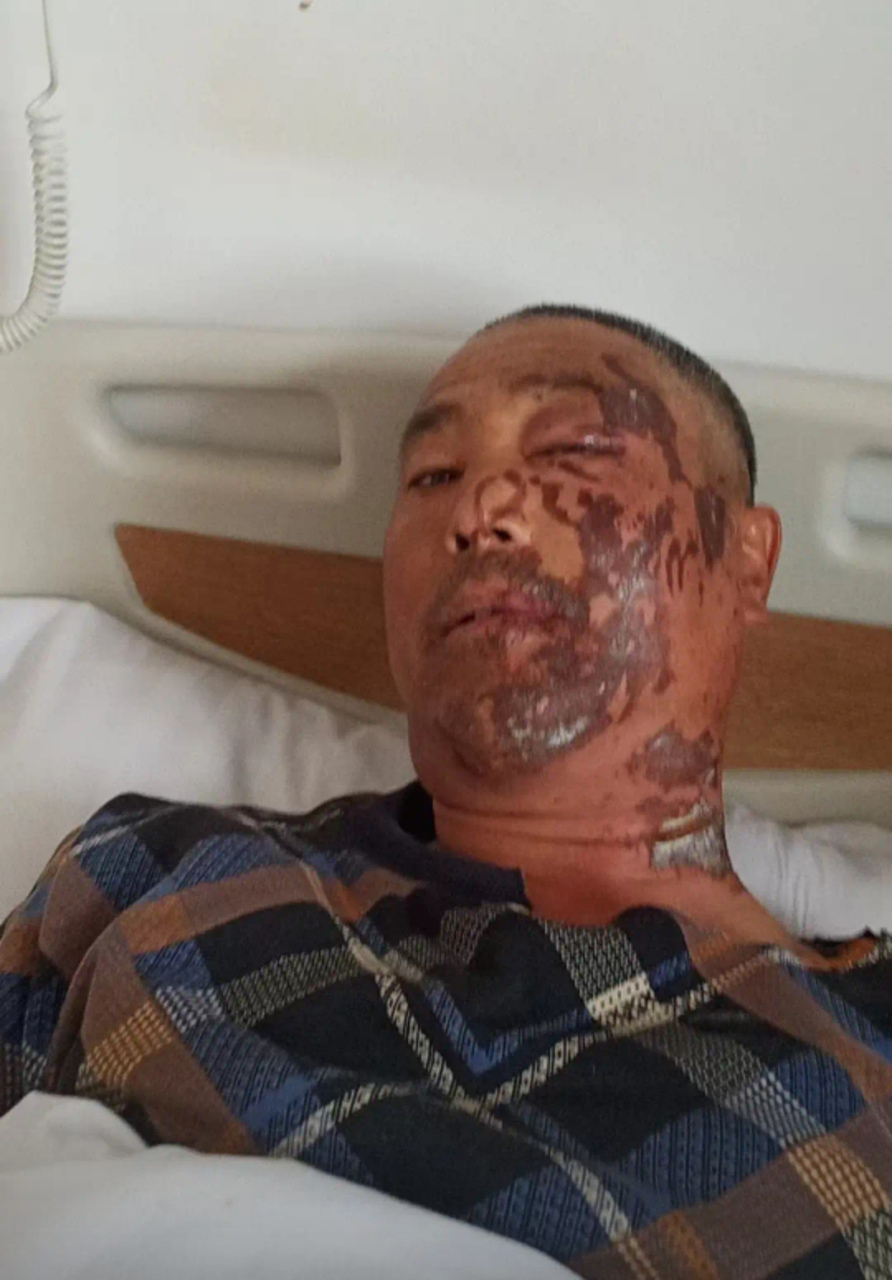 家父在工地上上班被硫酸腐蚀到面部了,家里人都是农村的没有这方面经