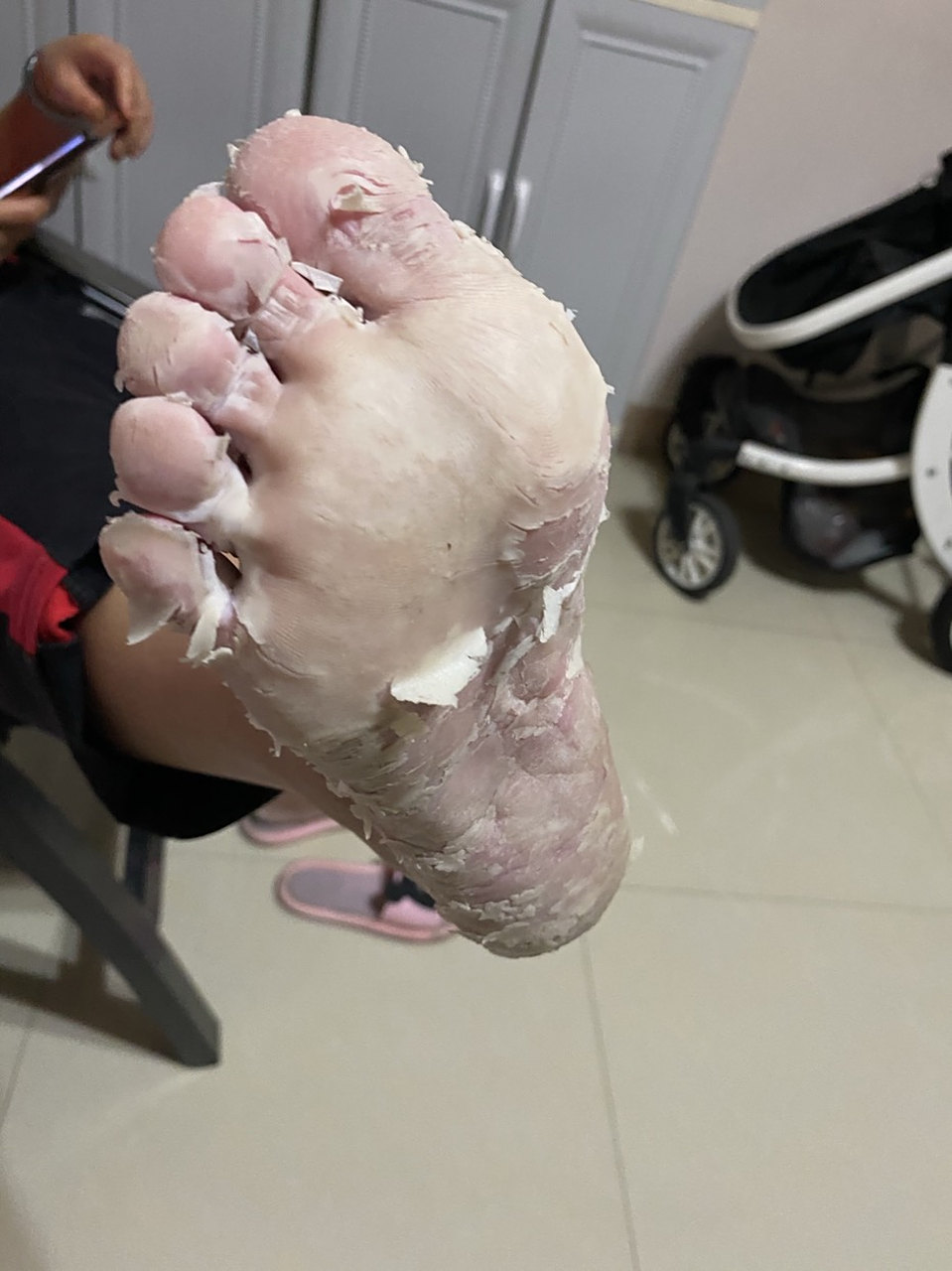 真菌感染要多泡几次脚, 脱完皮应该就重获新生了吧
