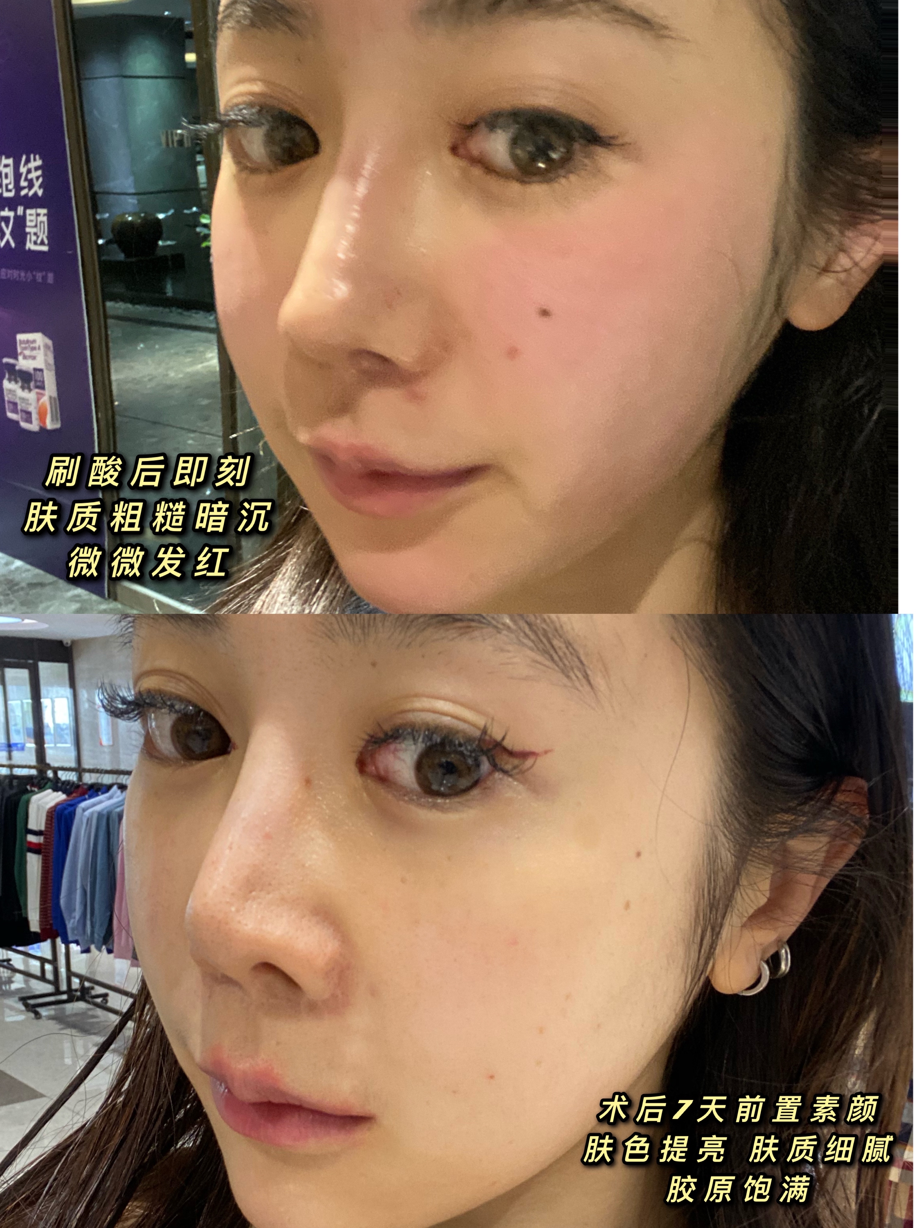 果酸焕肤|敏感肌祛痘能刷酸吗
