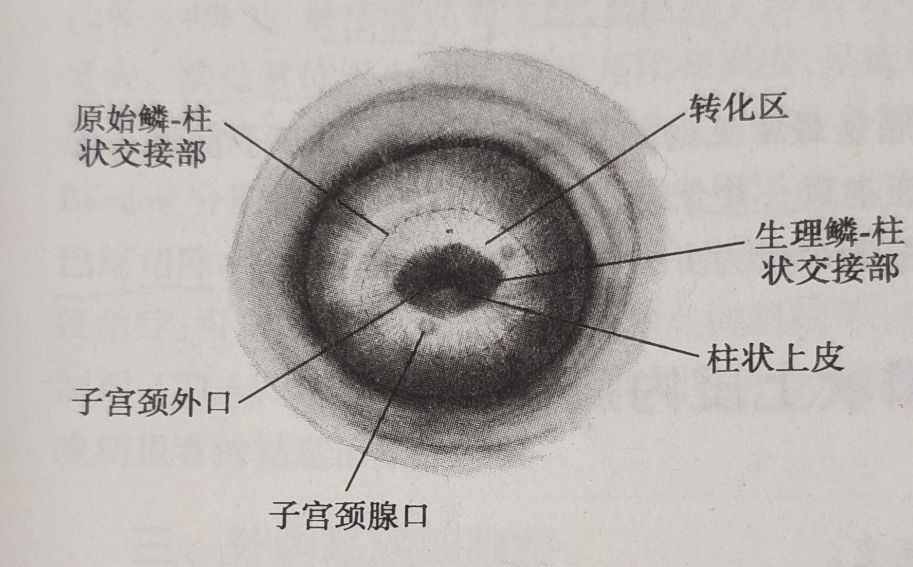 宫颈纳囊是什么