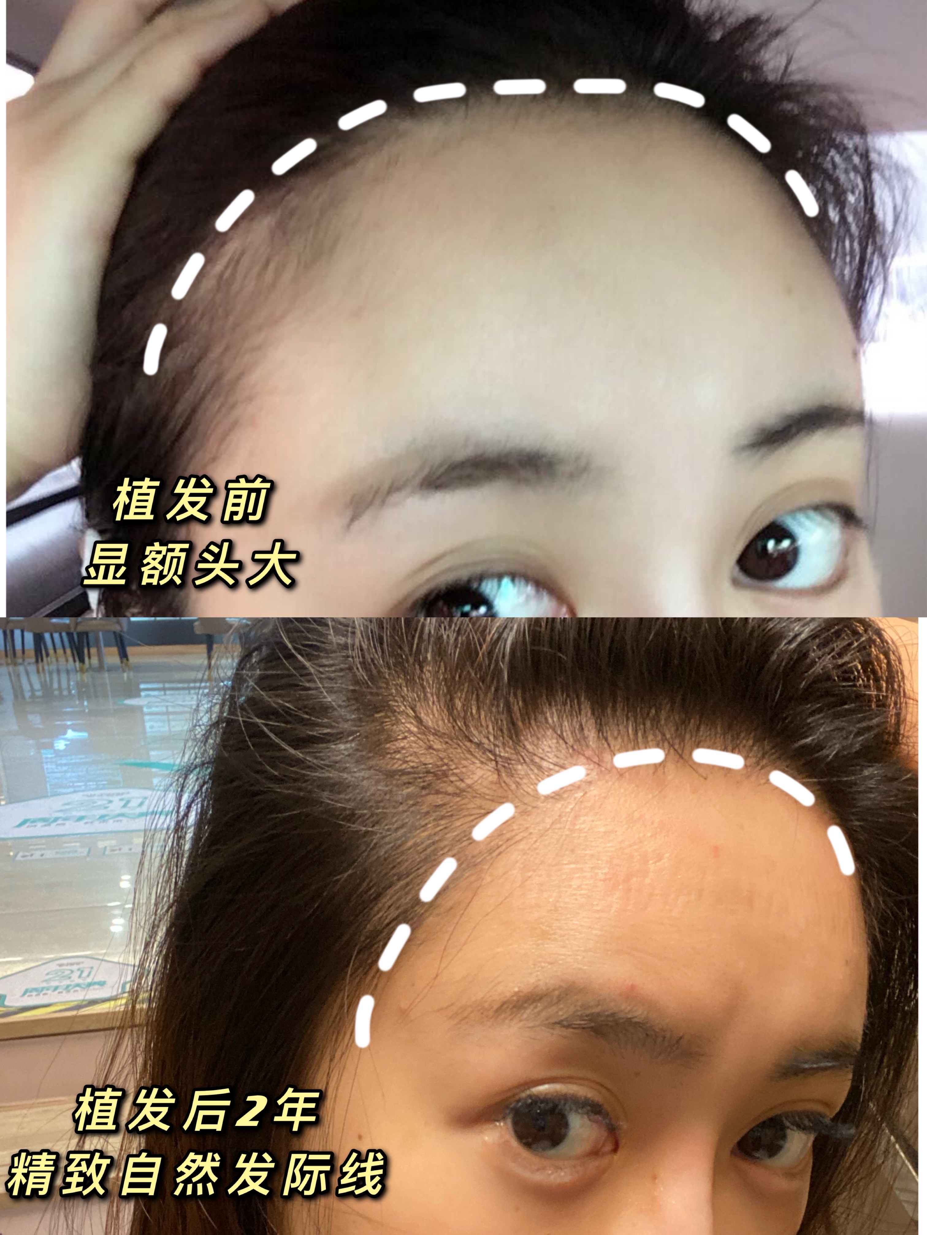 种植发际线后脑勺会斑秃吗?