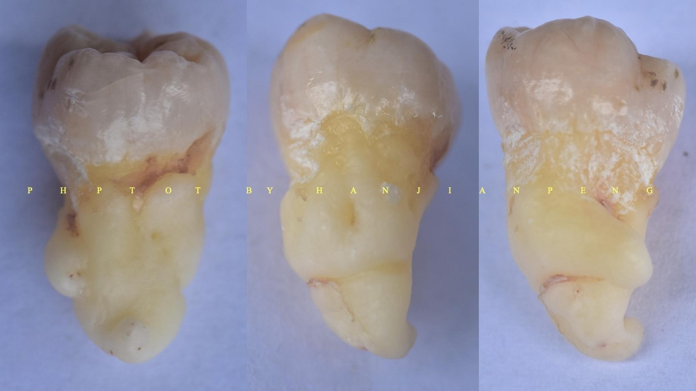 1颗有意思的智齿,牙根蜷曲如婴儿手脚蜷缩在一起.#智齿# #拔牙