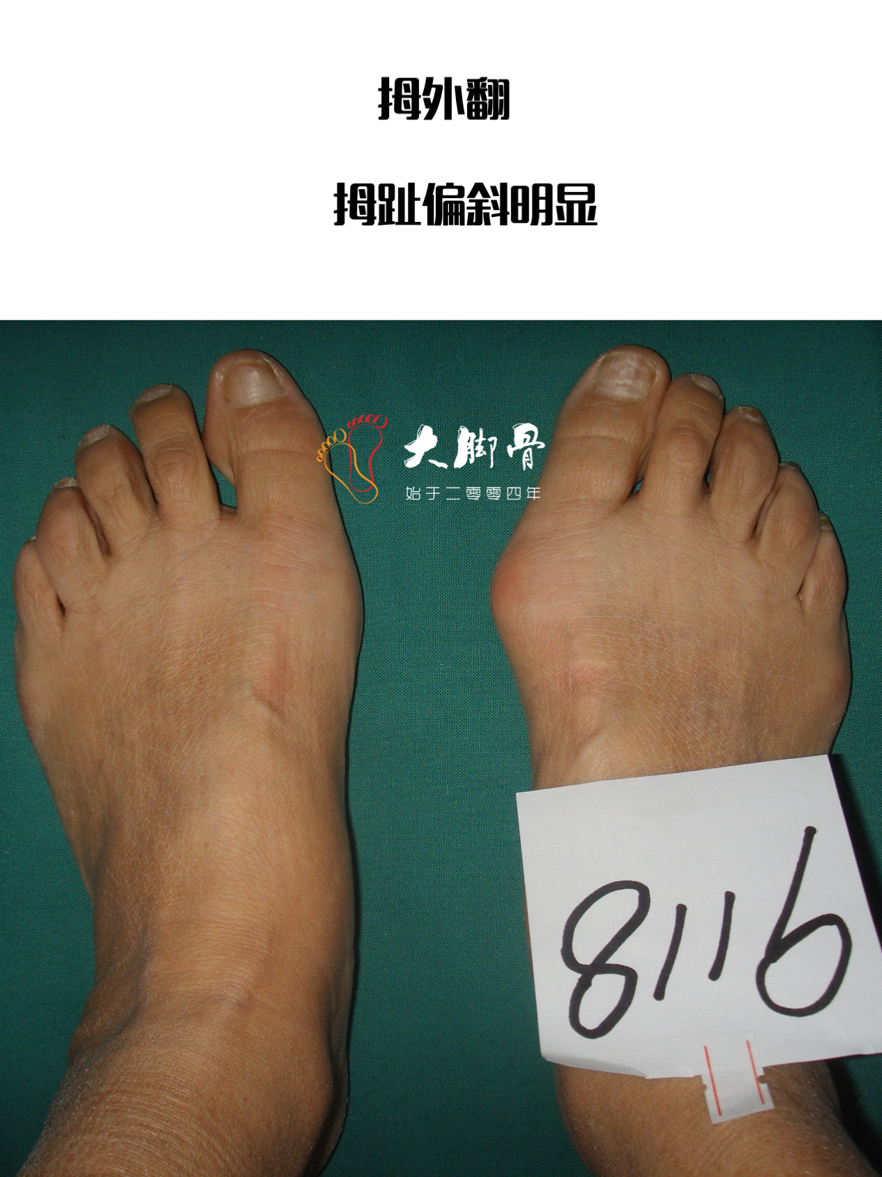 的拇外翻,由于拇趾向外侧偏斜,而里面的骨头其第一跖骨是向里面偏斜的