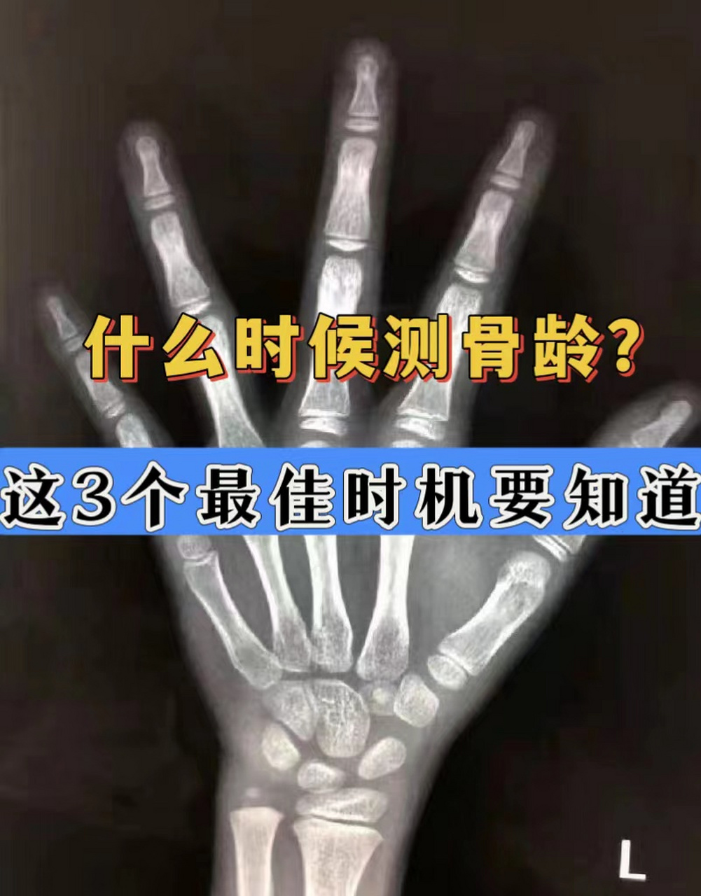 什么时候测骨龄,儿科主任:这3个时间点是测骨龄的最佳时机,建议家长