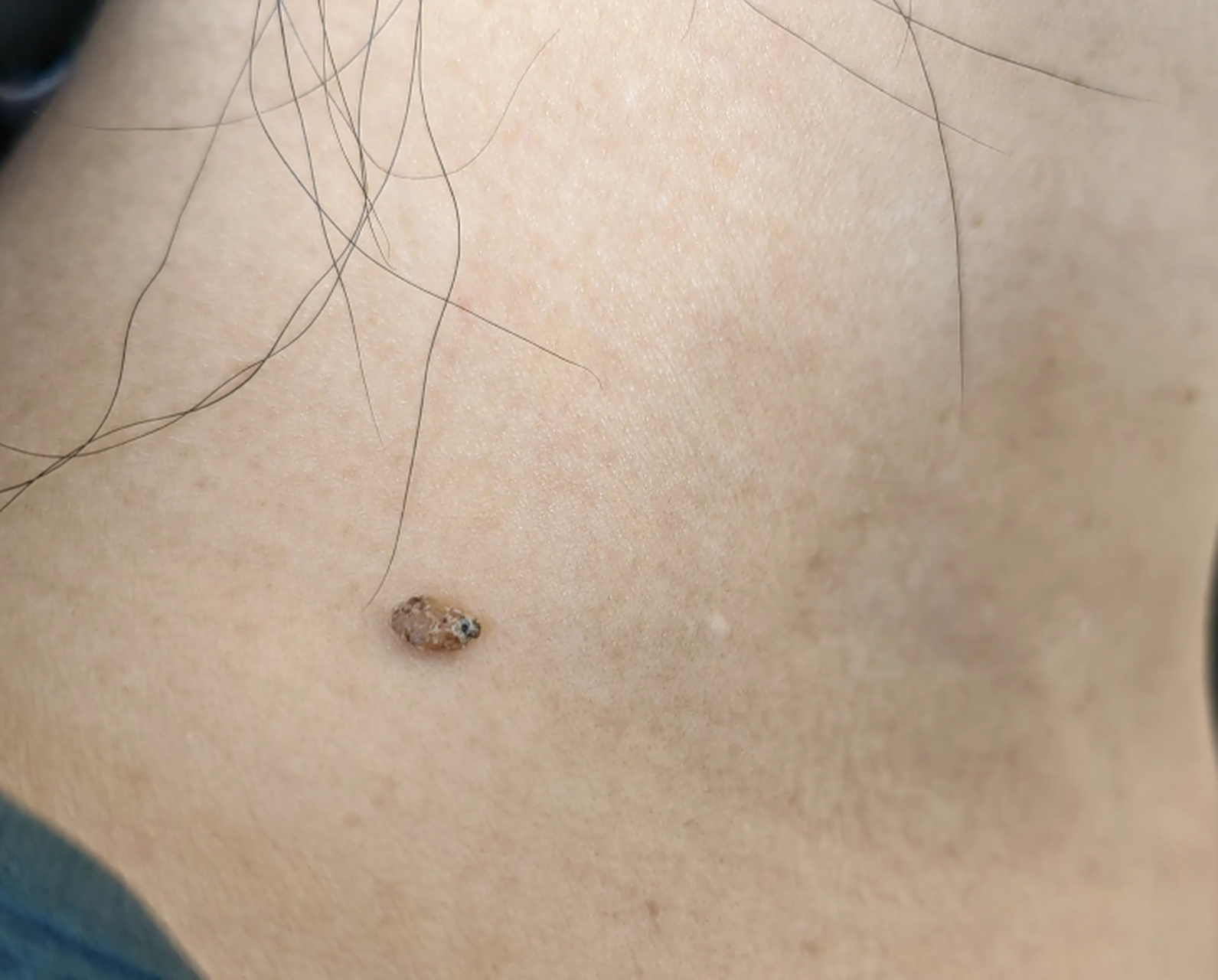 脖子上的疣,掉了    这位患者,一周前来看脖子上的寻常疣,今天给我