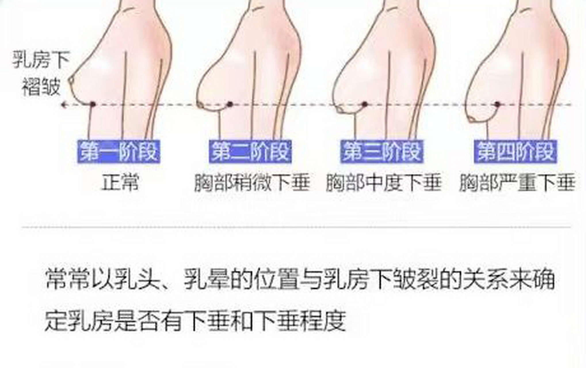 胸下垂怎么判断?