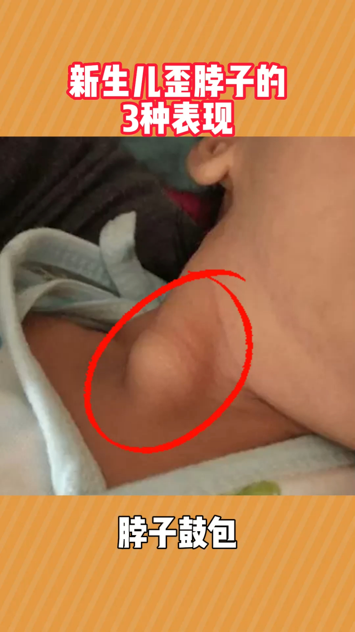 新生儿斜颈的三大表现   11566轻轻触摸宝宝脖子,能摸到硬硬的
