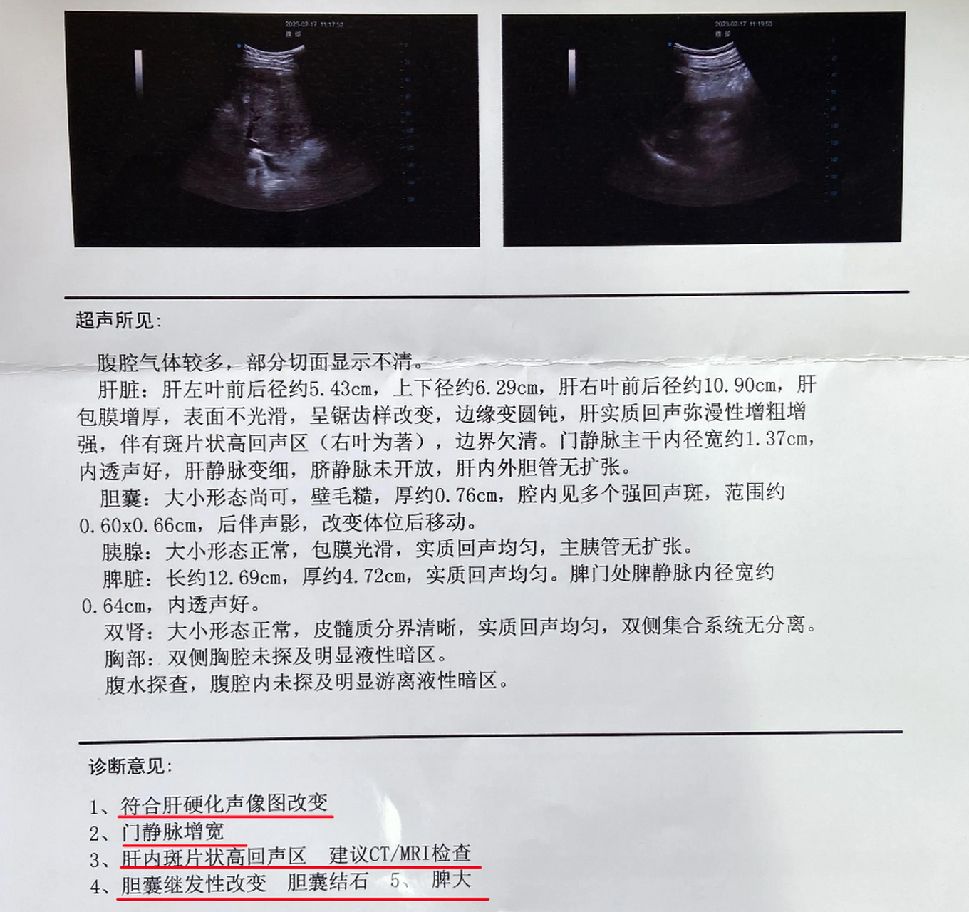 肝硬化彩超表现图片