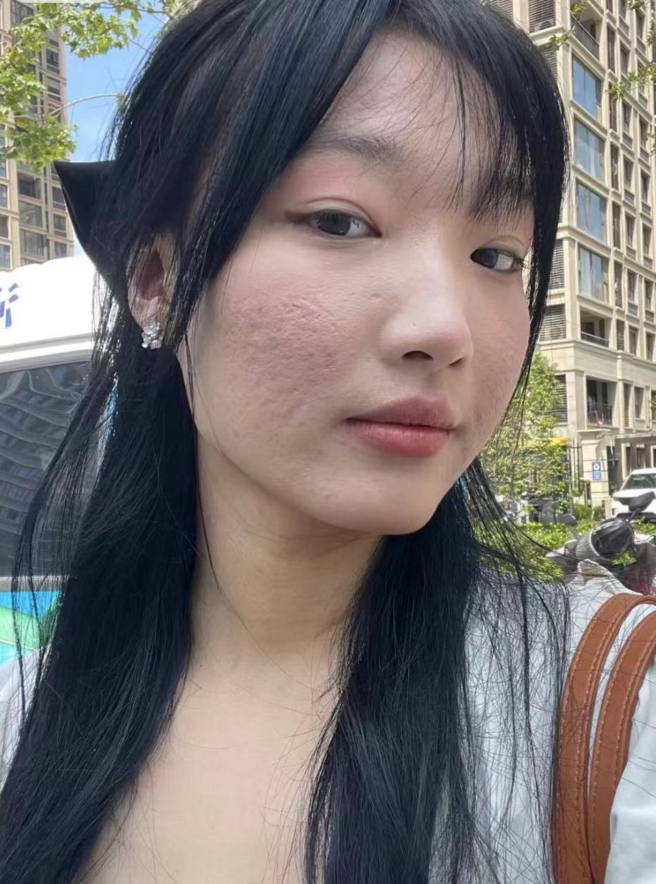 事实上,痘坑是可以修复的,只要采取正确的方法和措施,就能达到预期的