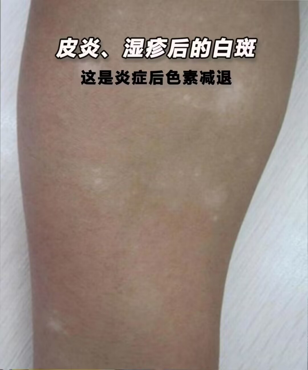 很多孩子皮炎,湿疹后长了白斑,家长也非常着急,害怕是白癜风 .