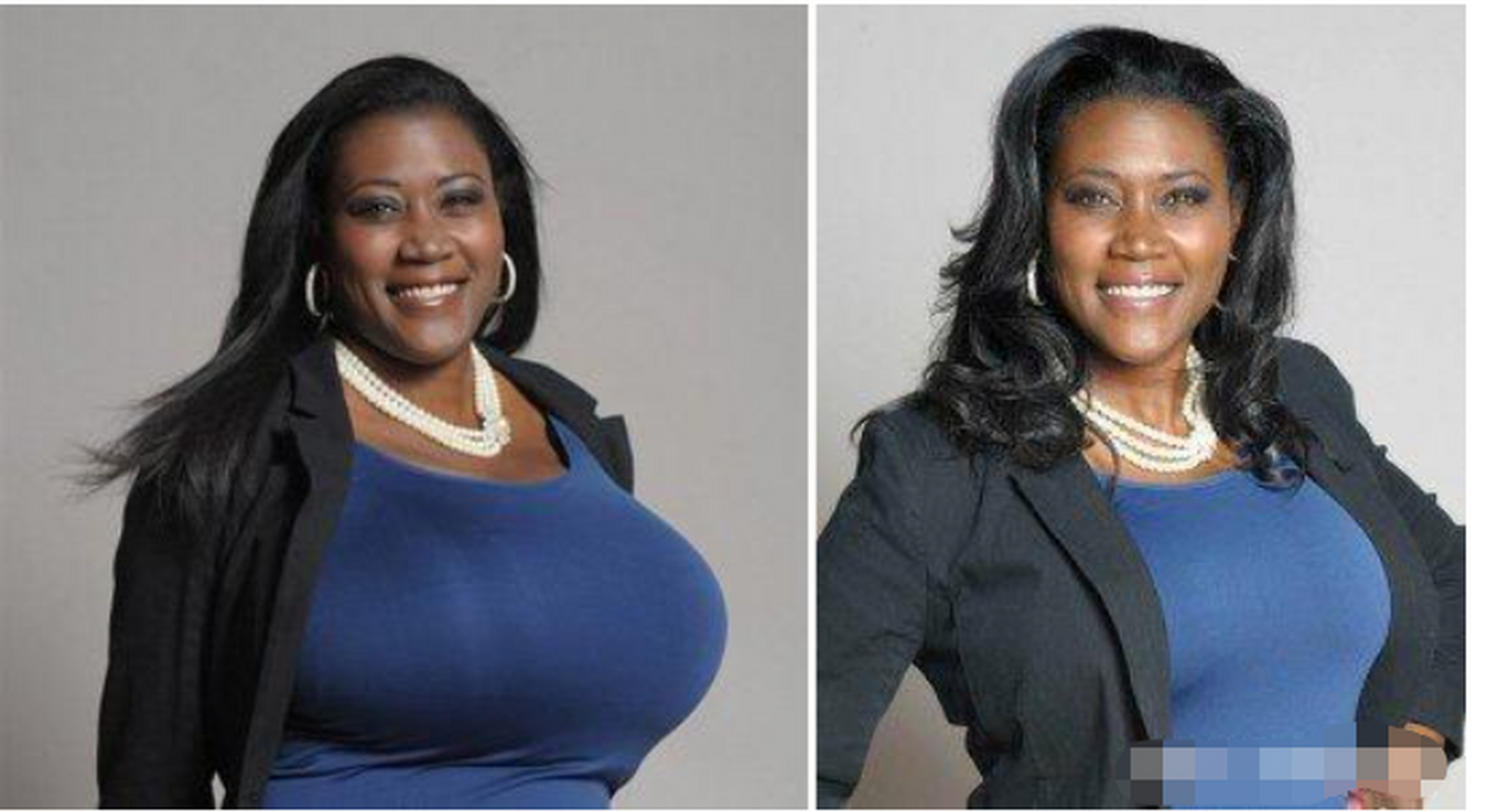 其实乳房缩小术对生育哺乳可能会有影响!