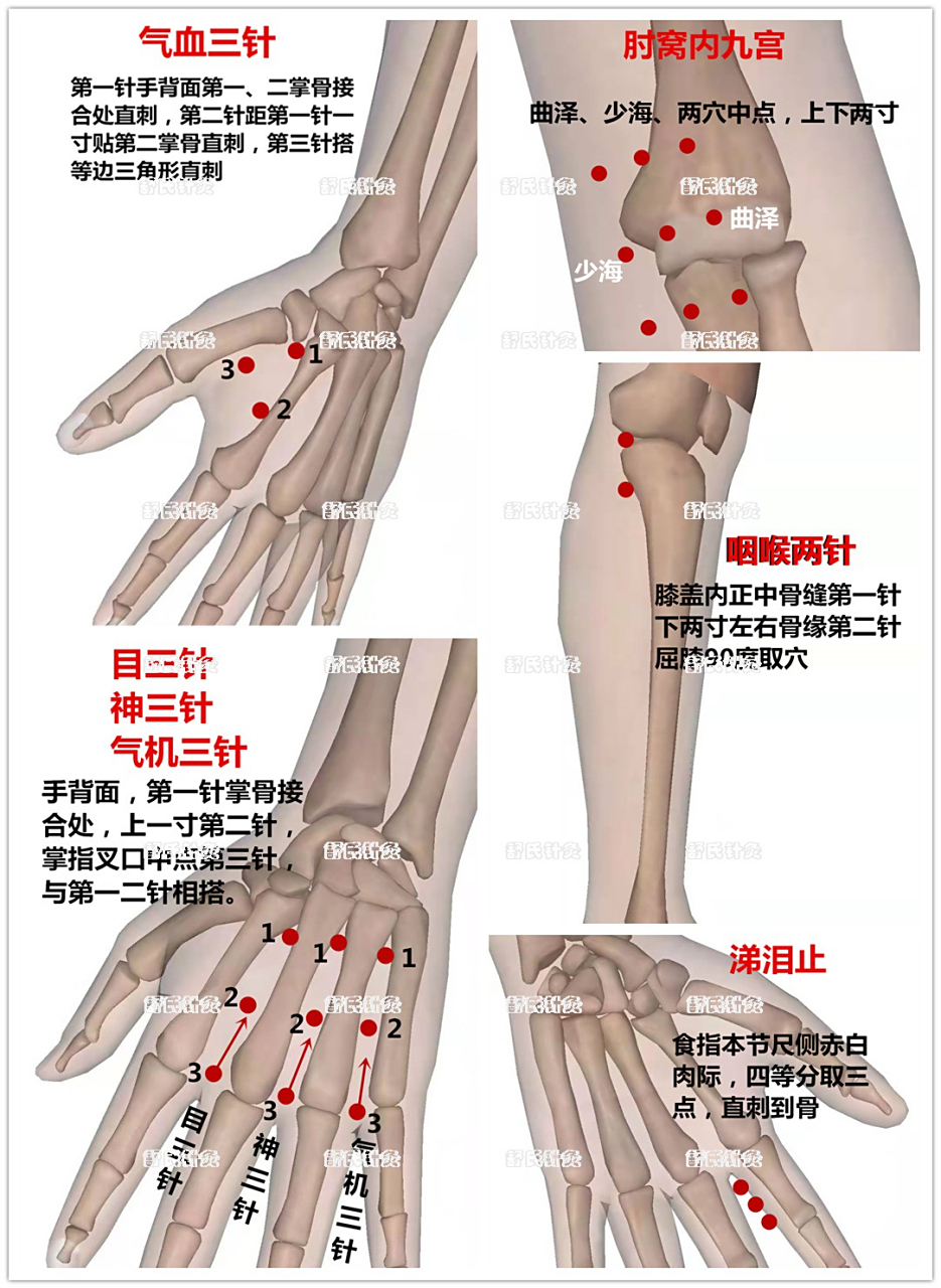 舒氏针灸·感冒头疼分享: 主穴:气血三针 配穴:单侧气机三针 嗓子痒