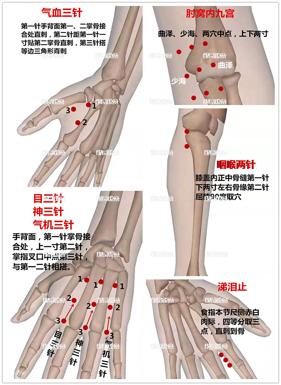 舒氏针灸·感冒头疼分享: 主穴:气血三针 配穴:单侧气机三针   嗓子痒