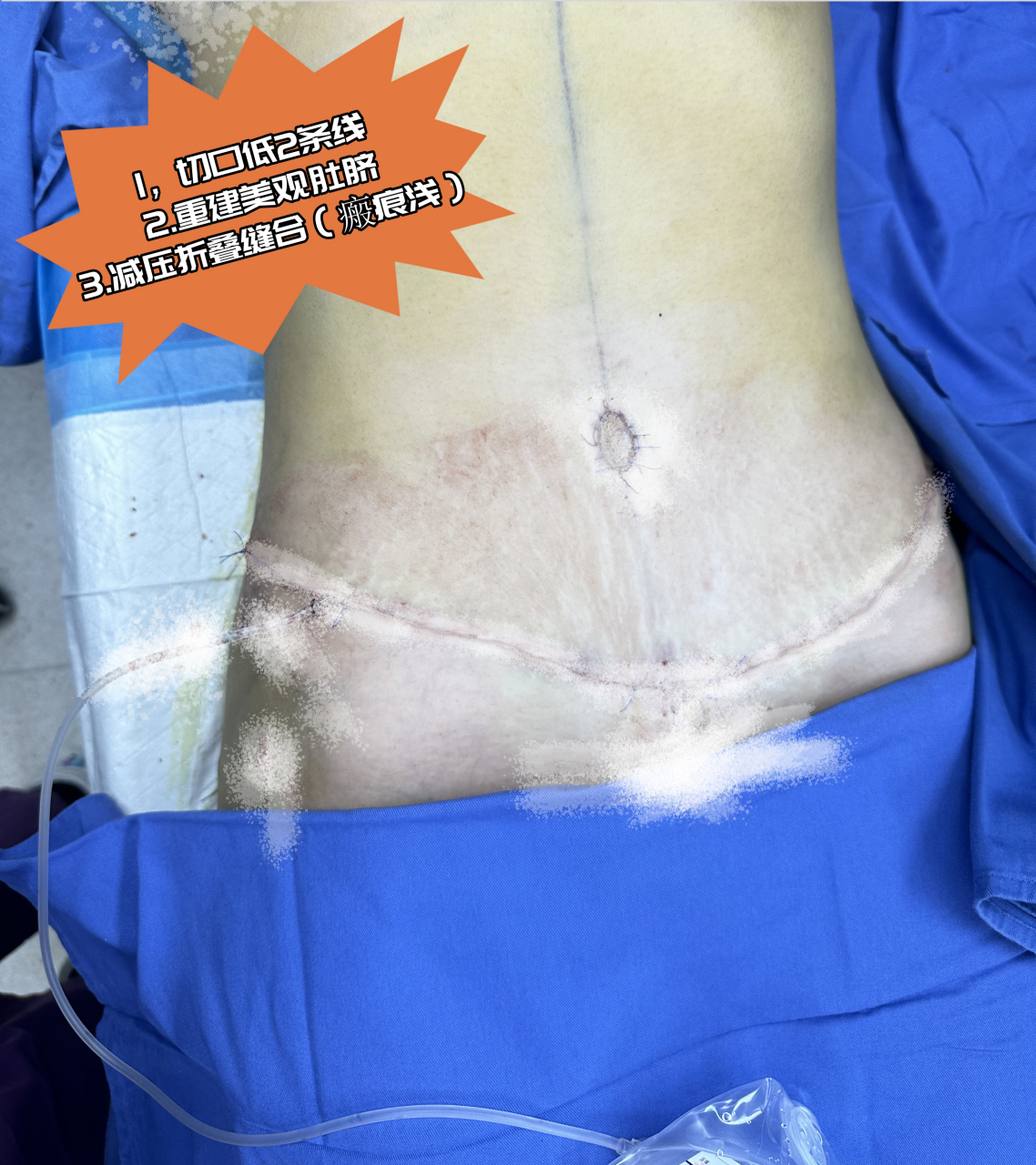 02腹壁整形术后第1天直接变细8公分73整形医生:这还只是肿胀期