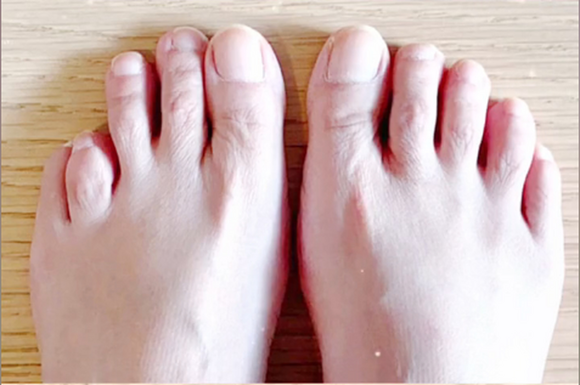 下面是一位短指症(脚趾)患者在我这做完手术后,在网络上回答的问题,仅