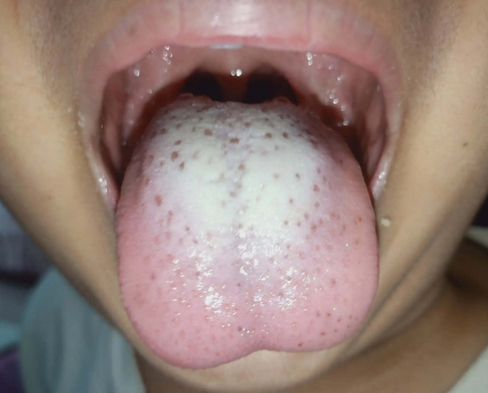 我们正常的舌苔通常是红色或粉红色的.