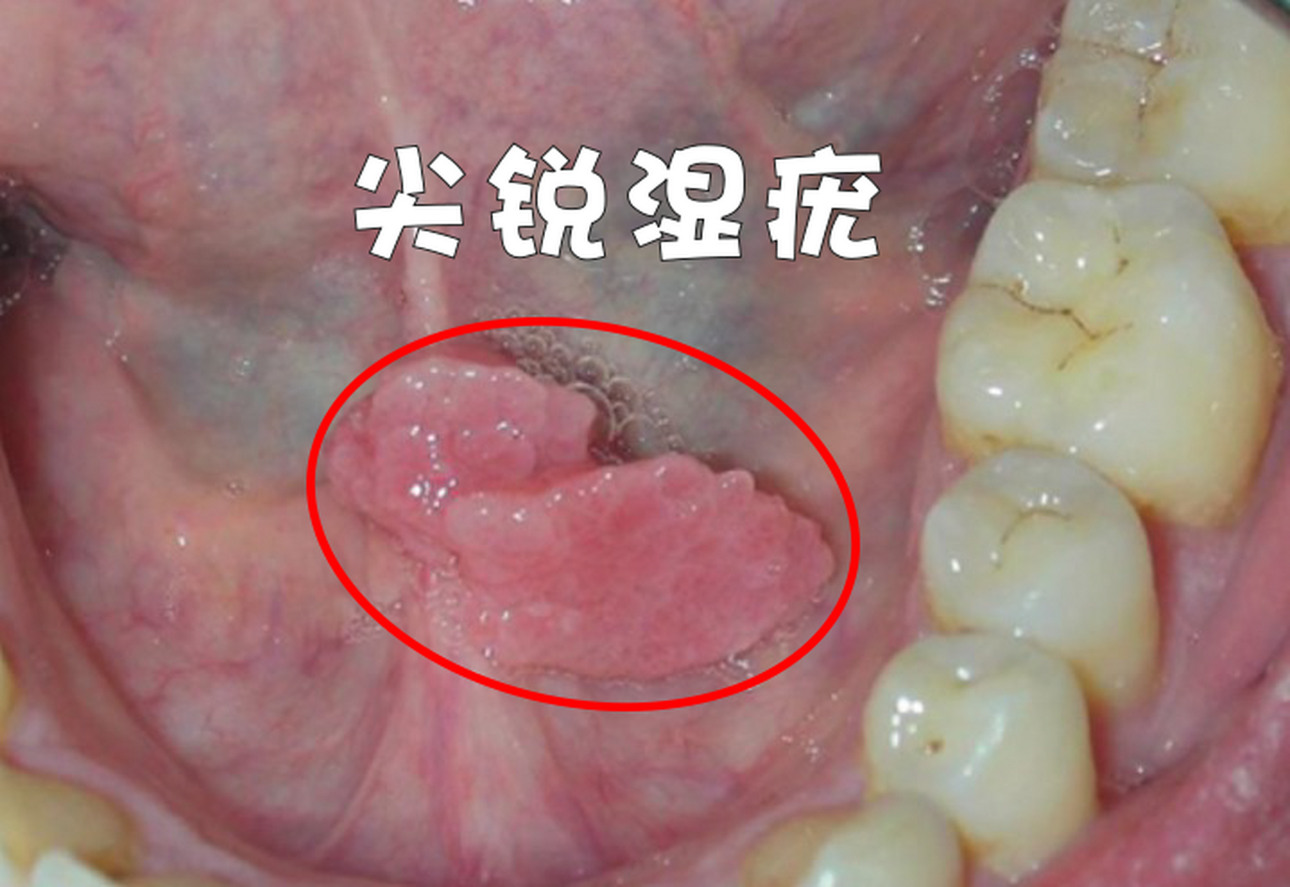 先来习惯性地说说尖锐湿疣,它主要由人类乳头瘤病毒(hpv)引起,是一