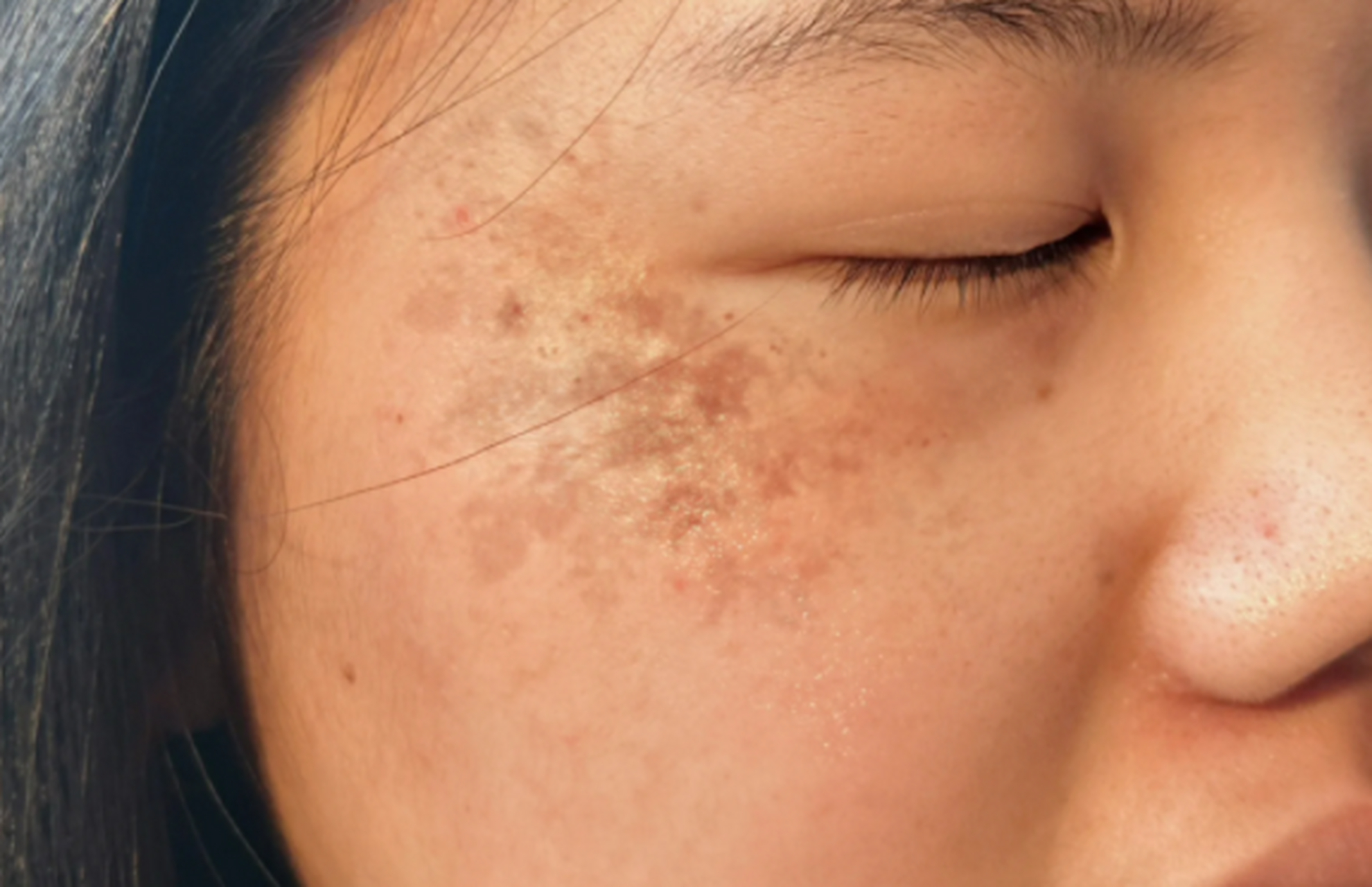 对我来说,去除太阳晒的黑斑是一项长期的挑战.